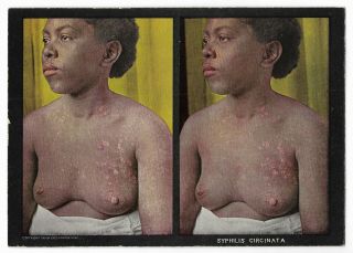 Antique 1910 Venereal Disease Stereoview Card Medical Syphilis African American