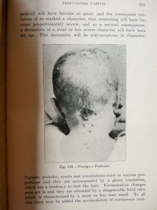 1908 DISEASES OF THE SKIN Antique MEDICAL BOOK GRAPHIC PLATES Anthrax LEPROSY 3