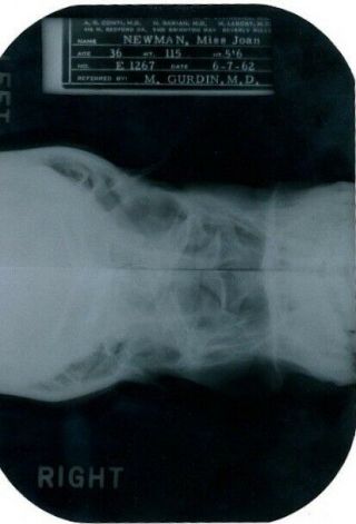 Very Rare Xray X - ray Marilyn Monroe Nasal Bones W/ 2