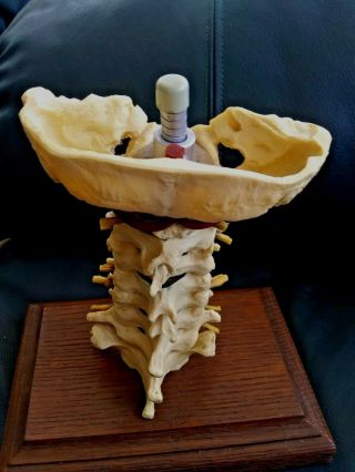 Rare Lumbar Spine Degeneration " Anatomiocal Chart Co.  Anatomy Chiropractic Model