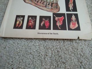 Antique Early 1900 ' s Diseases Of The Teeth Medical Picture Page 3