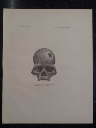 Prehistoric Trephining and Cranial Amulets Skull By Robert Fletcher Antique 1882 3